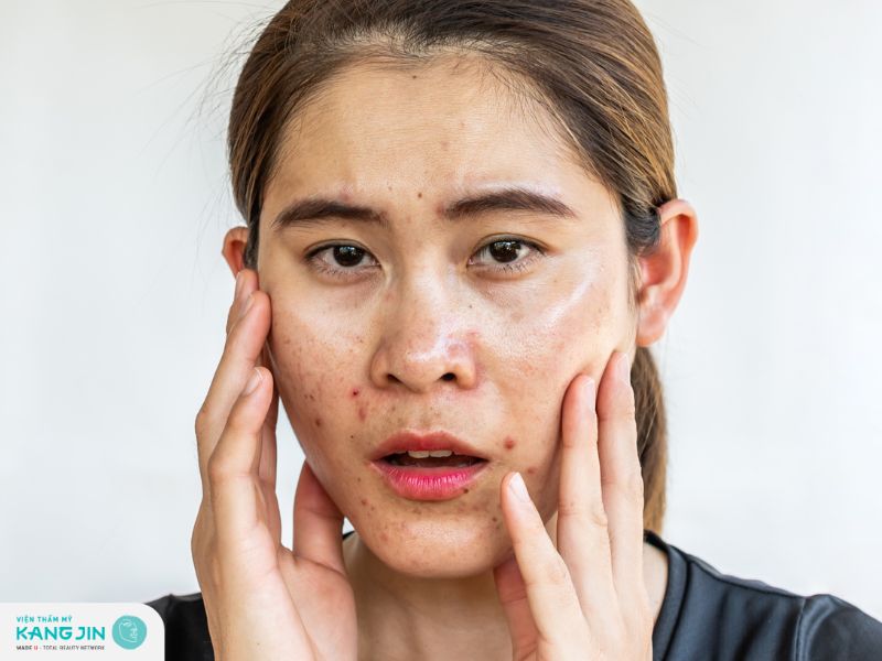 Tẩy tế bào chết giúp làm sạch lỗ chân lông giảm thiểu mụn ở da dầu 