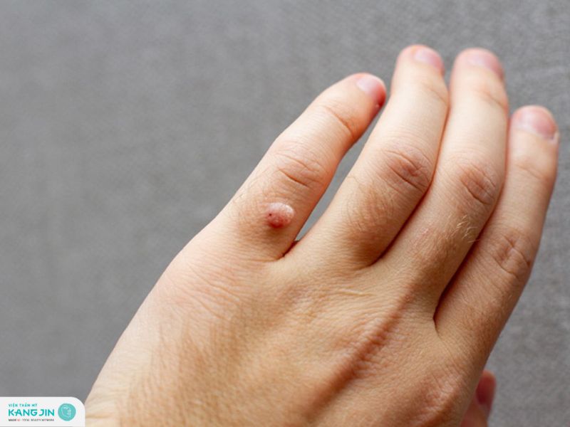 cách trị mụn cóc ở tay