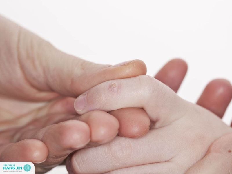 cách trị mụn cóc ở tay
